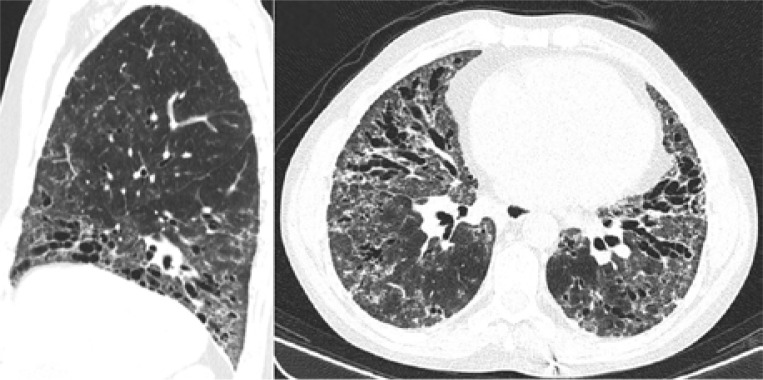 Systemic sclerosis and rheumatoid arthritis overlap syndrome - management of severe cardiac, pulmonary and articular involvement.