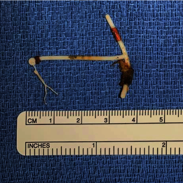 Robot-Assisted Removal of a Partially Intravesical Intrauterine Device (IUD) and Large Bladder Stone.