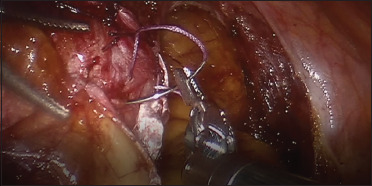 Robotic Sacrocolpopexy with Autologous Fascia Lata: A Case Series.