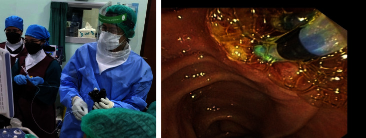 Endoscopic Management Using Novel Haemostatic Agents for Immediate Bleeding during Endoscopic Retrograde Cholangio-Pancreatography.