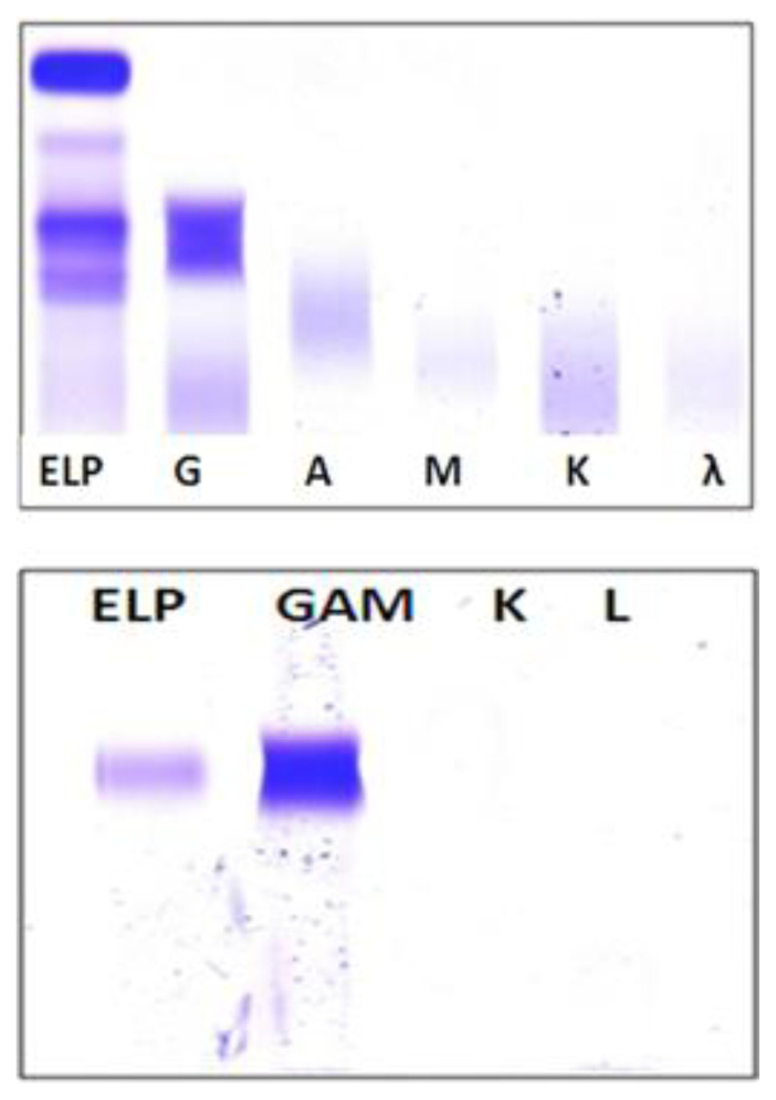 Gamma Heavy Chain Disease Associated with T-Cell Large Granular Lymphocyte Lymphoproliferative Disorder: Case Report and Literature Review.