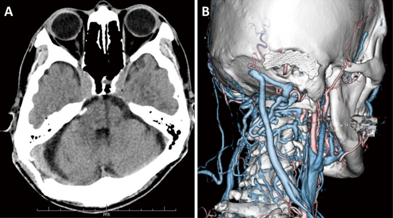 Preservation of Enlarged Mastoid Emissary Vein during Microvascular Decompression for Trigeminal Neuralgia Accompanied by Abnormal Venous Drainage: A Technical Case Report.