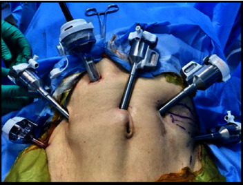 A Randomized Controlled Study of Robot-Assisted versus 3D Laparoscopic Radical Prostatectomy in Patients with Carcinoma Prostate.