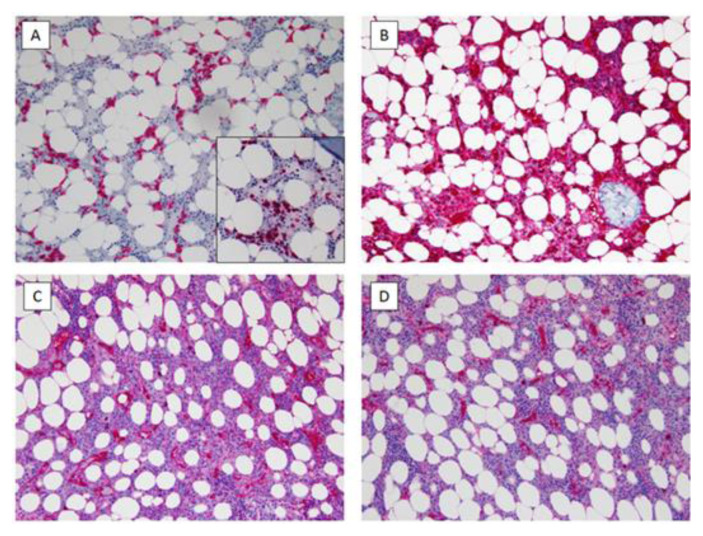 Gamma Heavy Chain Disease Associated with T-Cell Large Granular Lymphocyte Lymphoproliferative Disorder: Case Report and Literature Review.