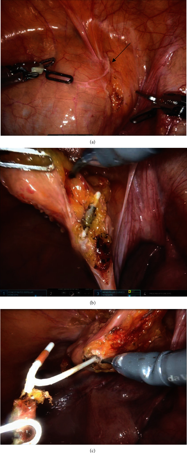 Robot-Assisted Removal of a Partially Intravesical Intrauterine Device (IUD) and Large Bladder Stone.