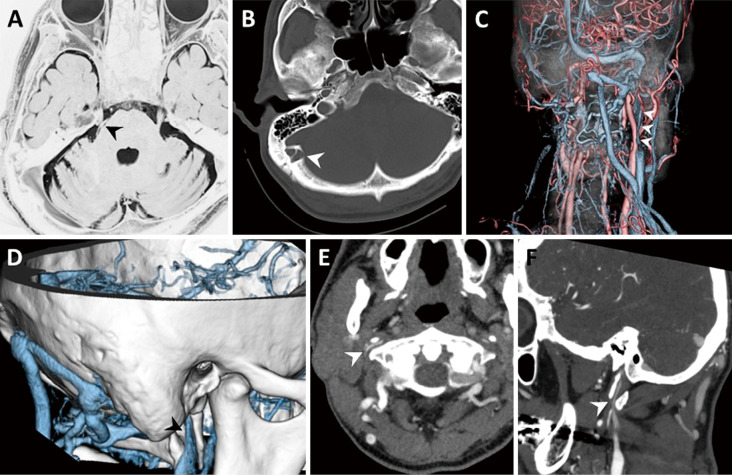 Preservation of Enlarged Mastoid Emissary Vein during Microvascular Decompression for Trigeminal Neuralgia Accompanied by Abnormal Venous Drainage: A Technical Case Report.