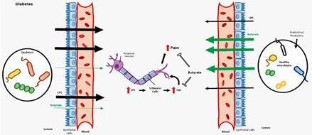 Impact of gut-peripheral nervous system axis on the development of diabetic neuropathy.