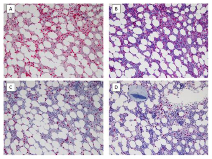 Gamma Heavy Chain Disease Associated with T-Cell Large Granular Lymphocyte Lymphoproliferative Disorder: Case Report and Literature Review.