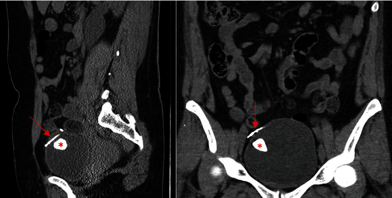 Robot-Assisted Removal of a Partially Intravesical Intrauterine Device (IUD) and Large Bladder Stone.