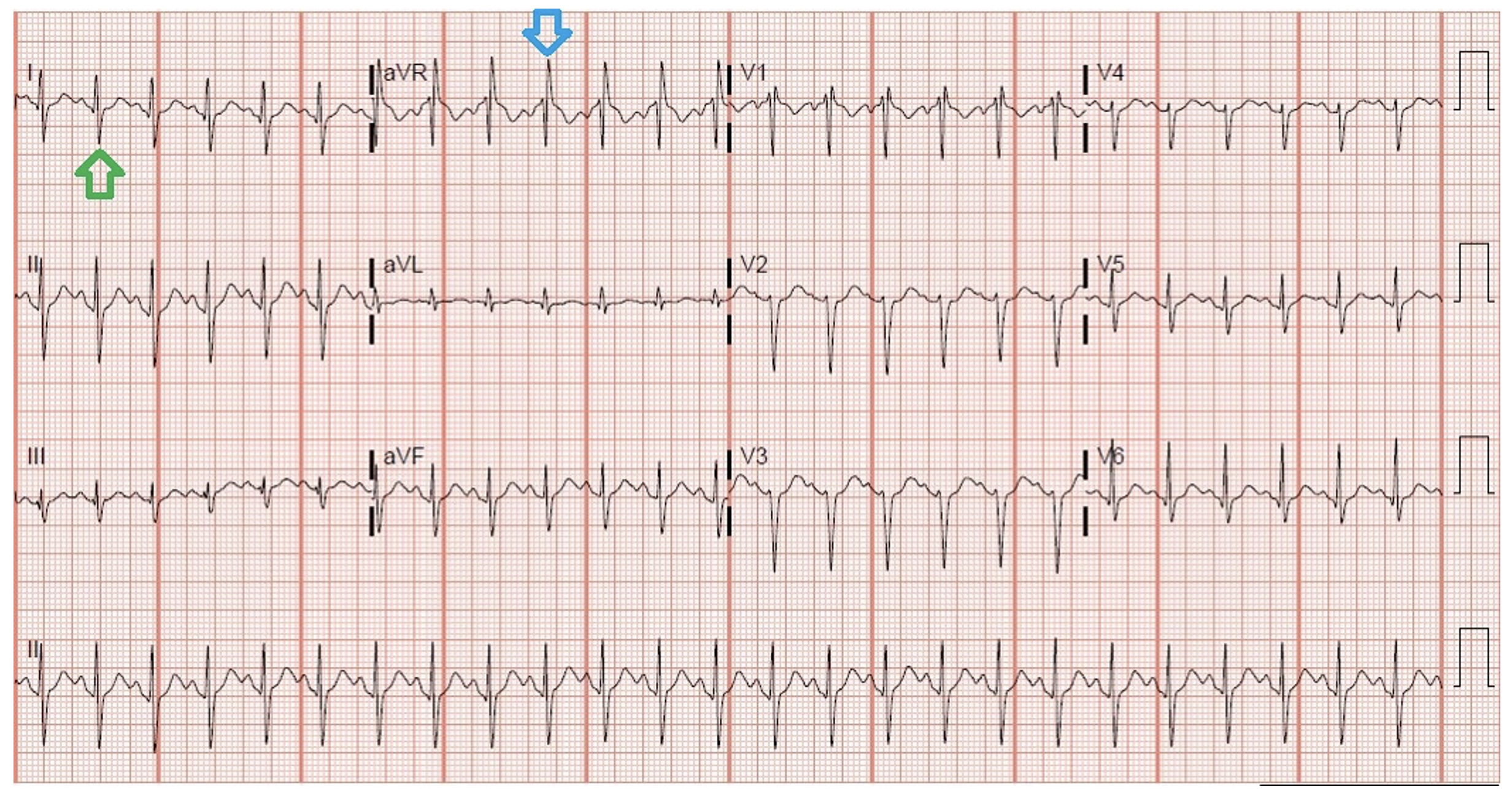 Electrocardiogram Abnormalities Following Diphenhydramine Ingestion: A Case Report.