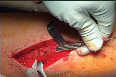 Robotic Sacrocolpopexy with Autologous Fascia Lata: A Case Series.