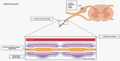 Impact of gut-peripheral nervous system axis on the development of diabetic neuropathy.