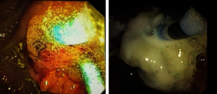 Endoscopic Management Using Novel Haemostatic Agents for Immediate Bleeding during Endoscopic Retrograde Cholangio-Pancreatography.