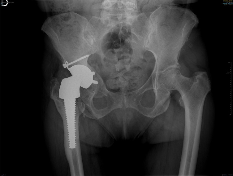 Analysis of an explanted dual mobility cup after 21 years, parabolic wear pattern: A case report.