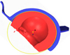 Analysis of an explanted dual mobility cup after 21 years, parabolic wear pattern: A case report.