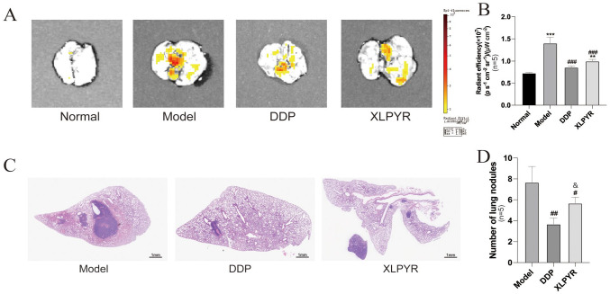 Xiaoliu Pingyi Pecipe Inhibits Lung Pre-Metastatic Niche Formation and Prevents Myeloid-Derived Suppressor Cells Recruitment.