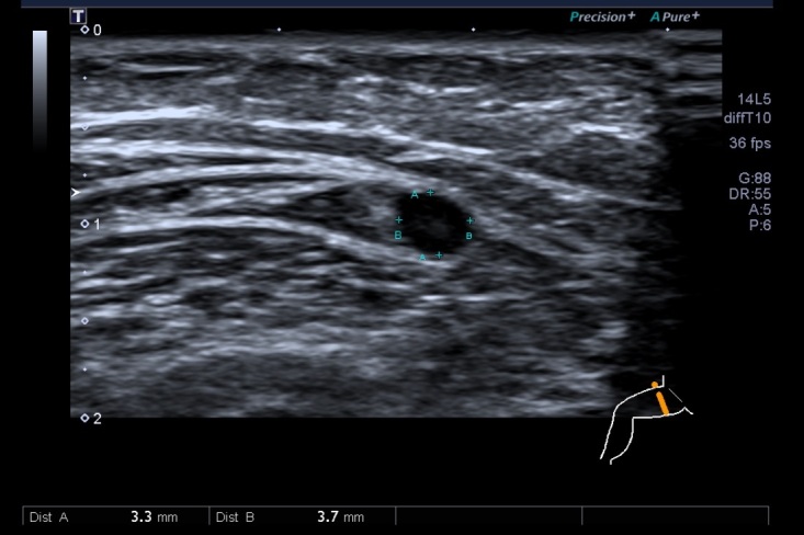 Correlations between ultrasound, tomographic, and intraoperative measurements of the great saphenous vein used as an arterial graft.