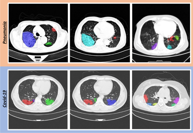 Detection and classification of COVID-19 by using faster R-CNN and mask R-CNN on CT images.