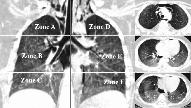 Correlation between CT Score and KL-6: A Severity Assessing in Juvenile Dermatomyositis Associated Interstitial Lung Disease.