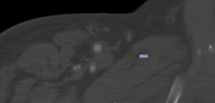 Correlations between ultrasound, tomographic, and intraoperative measurements of the great saphenous vein used as an arterial graft.