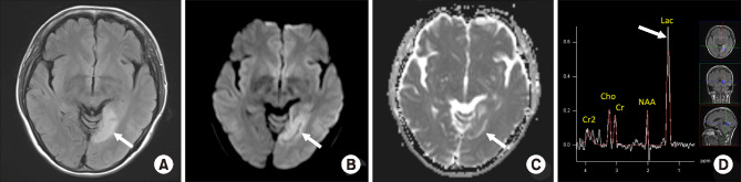 Magnetic Resonance Imaging and Spectroscopy of the Brain in MELAS Syndrome.