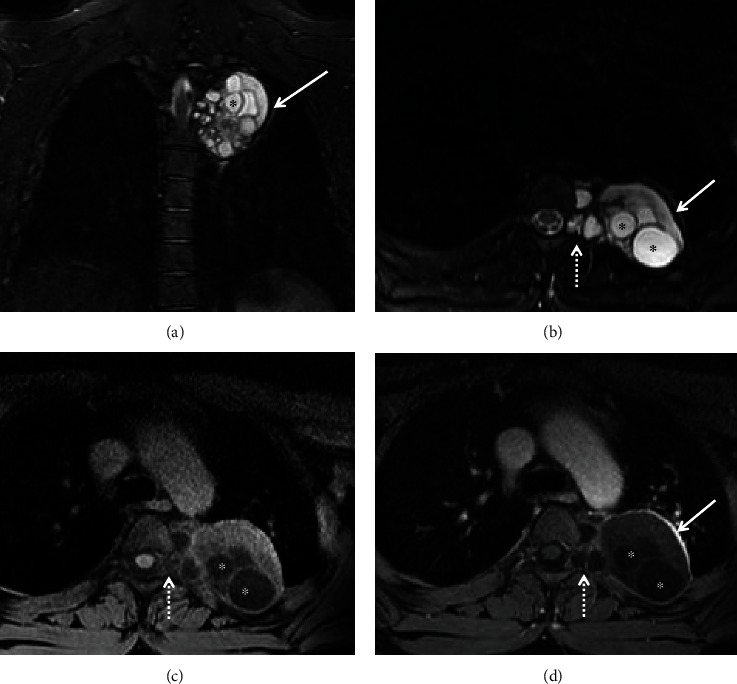 Primary Chest Wall Hydatid Disease: A Case Report with Multimodality Imaging Findings.