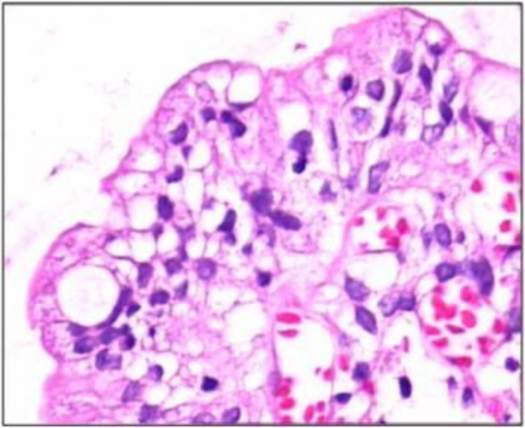 Not all enteropathies are coeliac disease! Report of an infant with microvillus inclusion disease.