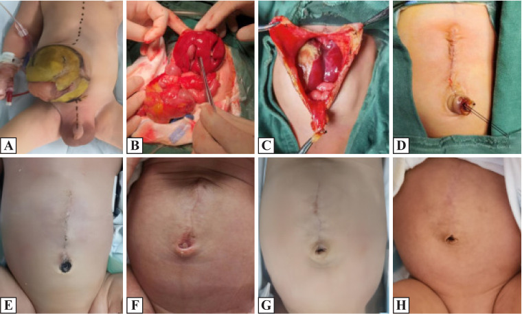 Umbilical cord sparing technique of umbilicoplasty in infants with giant omphalocele.