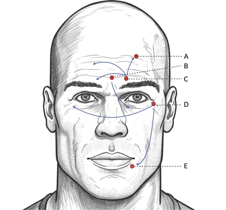 Keeping up appearances: Don’t frown upon the effects of botulinum toxin injections in facial muscles