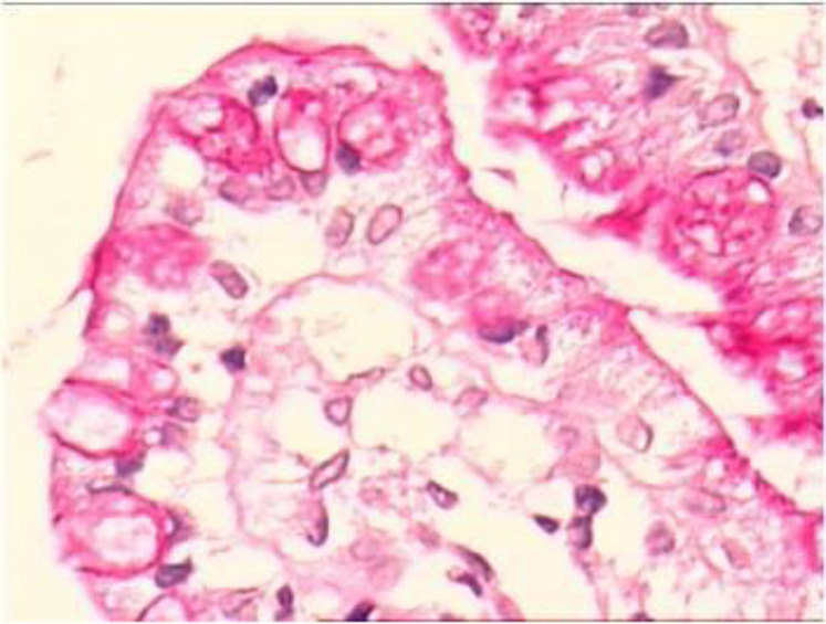 Not all enteropathies are coeliac disease! Report of an infant with microvillus inclusion disease.