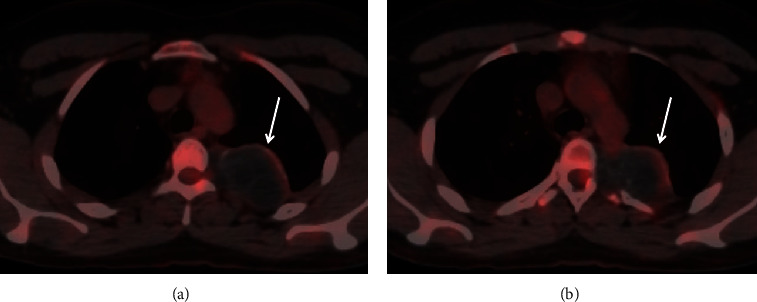 Primary Chest Wall Hydatid Disease: A Case Report with Multimodality Imaging Findings.