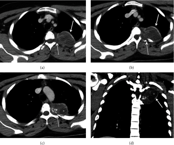 Primary Chest Wall Hydatid Disease: A Case Report with Multimodality Imaging Findings.