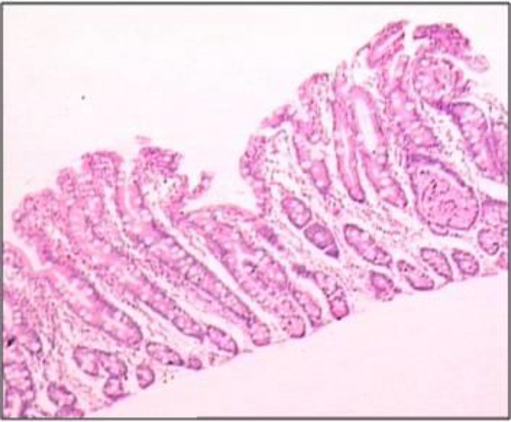 Not all enteropathies are coeliac disease! Report of an infant with microvillus inclusion disease.