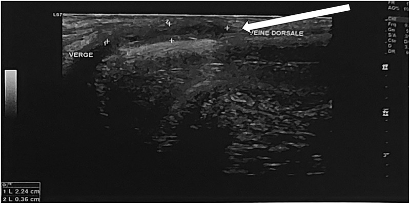 Thrombosis of the deep dorsal vein of the penis caused by vaccine-induced thrombotic thrombocytopenia: First reported case.