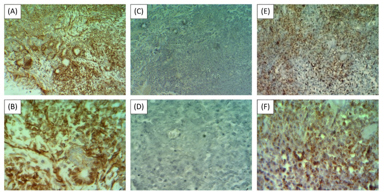 Cytotoxicity of WT1-reactive T cells against Wilms tumor: An implication for antigen-specific adoptive immunotherapy.