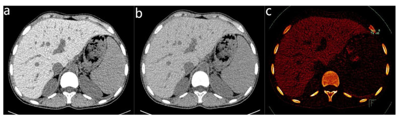 Quantitative Analysis of Liver Iron Deposition Based on Dual-Energy CT in Thalassemia Patients.