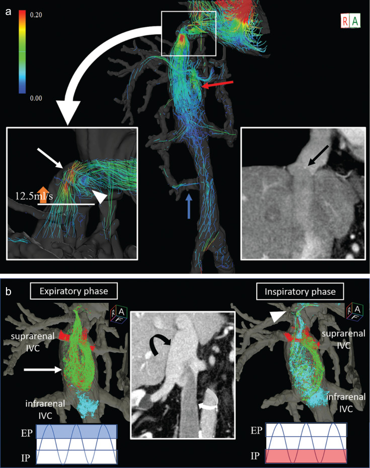 Assessing the Complicated Venous Hemodynamics and Therapeutic Outcomes of Budd-Chiari Syndrome with Respiratory-gated 4D Flow MR Imaging During the Expiratory and Inspiratory Phases.