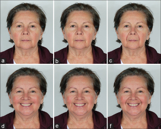 The Esthetics of the Nasolabial Fold and Age in the Elderly Via Eye-Tracking.