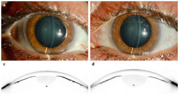 Combined Capsular Tension Ring and Segment Implantation in Phacoemulsification Surgery for the Management of Microspherophakia with Secondary Angle-Closure Glaucoma.