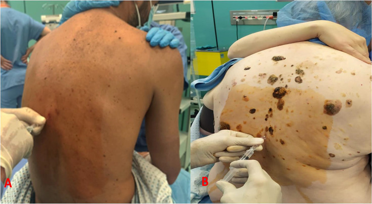 Segmental Thoracic Spinal Anesthesia for Laparoscopic Cholecystectomy with the "Hypobaric" Technique: A Case Series.