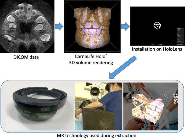 Mixed reality for extraction of maxillary mesiodens.