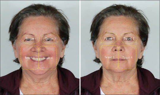 The Esthetics of the Nasolabial Fold and Age in the Elderly Via Eye-Tracking.