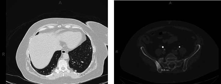 A PAX-8-Positive Female Urethral Adenocarcinoma, Intestinal-Type: A Case Report with Diagnostic Challenges and a Review of the Literature.