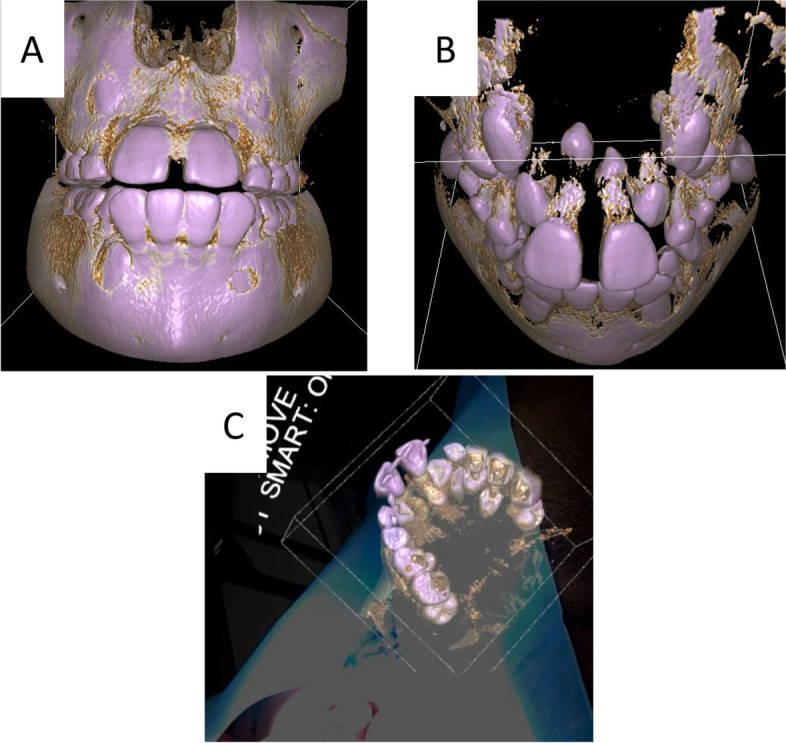 Mixed reality for extraction of maxillary mesiodens.