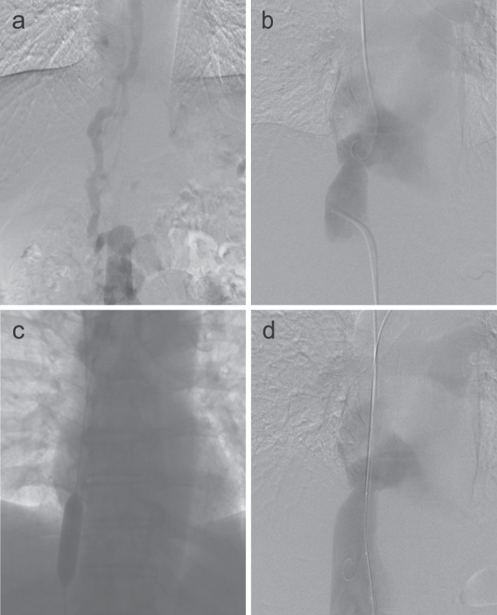 Assessing the Complicated Venous Hemodynamics and Therapeutic Outcomes of Budd-Chiari Syndrome with Respiratory-gated 4D Flow MR Imaging During the Expiratory and Inspiratory Phases.