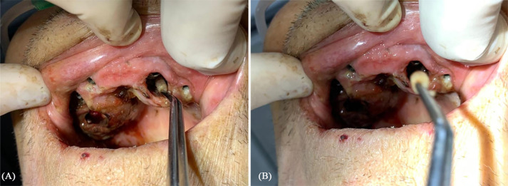 Treatment of oral myiasis in a patient with implant-supported fixed prosthesis.