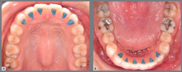 Dentoalveolar changes observed after the use of customized bonded Shark-Tooth-Like Spurs (JAWs) in adult patients with anterior open bite.