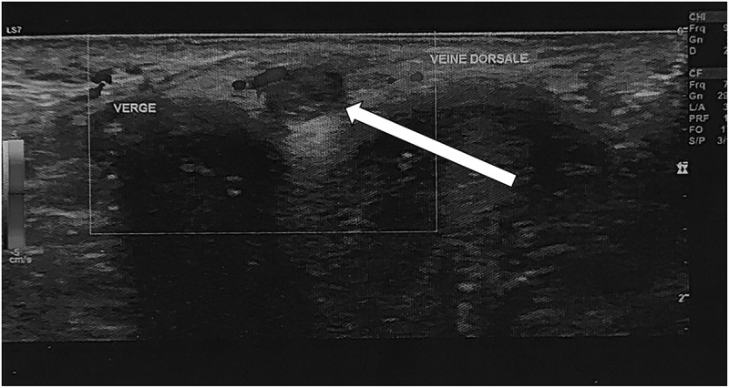 Thrombosis of the deep dorsal vein of the penis caused by vaccine-induced thrombotic thrombocytopenia: First reported case.