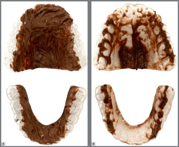 Dentoalveolar changes observed after the use of customized bonded Shark-Tooth-Like Spurs (JAWs) in adult patients with anterior open bite.