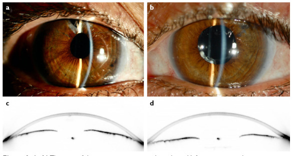 Combined Capsular Tension Ring and Segment Implantation in Phacoemulsification Surgery for the Management of Microspherophakia with Secondary Angle-Closure Glaucoma.